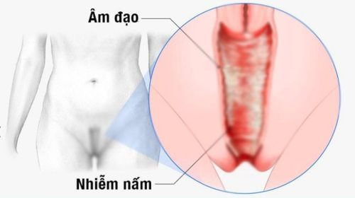 Nấm vùng kín ở nữ giới: Những thông tin chị em không thể bỏ qua!