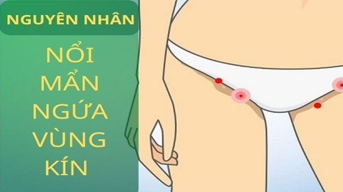 Nguyên nhân bị nổi mụn ở mép vùng kín mà chị em cần lưu ý!