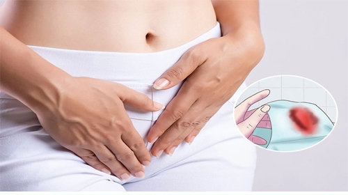 Đi tiểu ra máu ở nữ: “Cảnh báo” dấu hiệu nguy hiểm