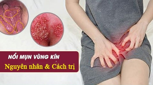 Nổi mụn mủ ở vùng kín có thể là dấu hiệu của bệnh gì?