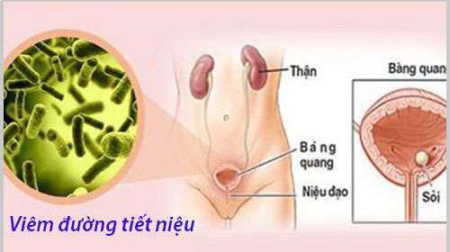 Nhiễm trùng đường tiết niệu ở nữ – Nguy cơ gây vô sinh cao