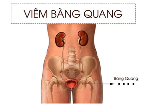 Viêm bàng quang nữ: Dấu hiệu, nguyên nhân và cách điều trị