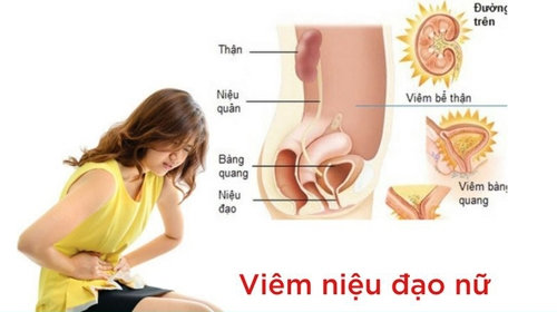 Viêm Niệu Đạo Ở Nữ Dấu Hiệu Nguy Hiểm Bạn Cần Biết Ngay
