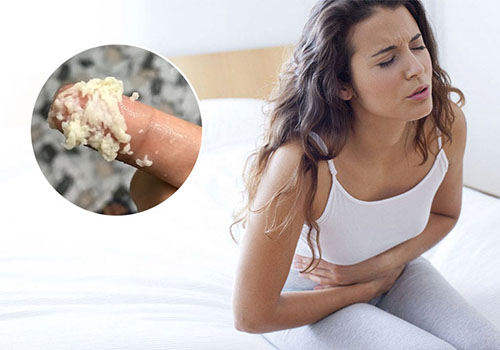 Ra khí hư vón cục như bã đậu: Cảnh báo bệnh lý nguy hiểm ở nữ giới!