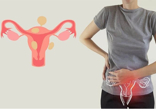 Các dấu hiệu bị viêm phụ khoa ở nữ giới