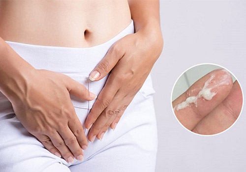 Khí hư màu trắng đục có mùi chua cảnh báo bệnh lý nào?