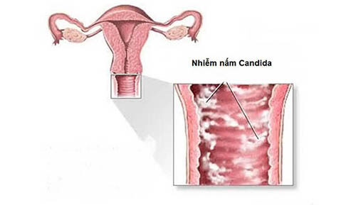 Nhiễm nấm Candida có tự khỏi không? Cách trị nấm Candida hiệu quả
