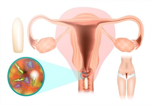 Biểu hiện thế nào là bị nấm vùng kín? Khi nào cần gặp bác sĩ?