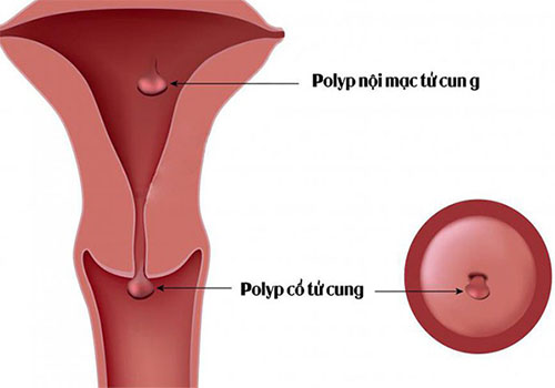 Polyp tử cung có nguy hiểm không? Sự thật mà chị em cần biết