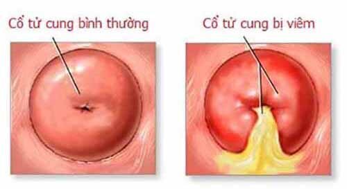 Viêm cổ tử cung: “Thủ phạm” gây vô sinh hàng đầu ở nữ giới