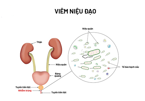 Triệu chứng viêm niệu đạo ở nữ giới là gì? Có nguy hiểm không?