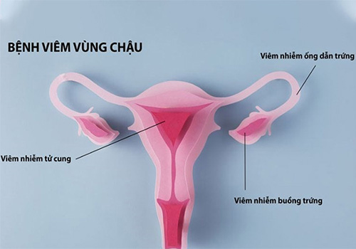 Viêm vùng chậu ở nữ giới có nguy hiểm không? Nguyên nhân và triệu chứng