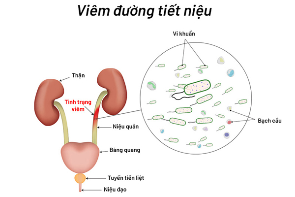 6 Dấu Hiệu Viêm Đường Tiết Niệu Nữ Không Thể Bỏ Qua