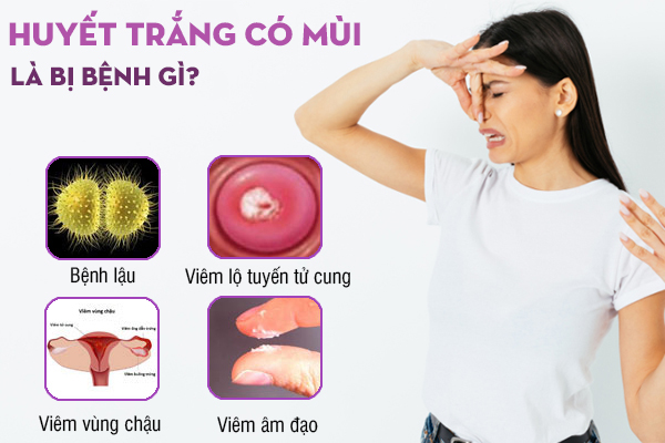 Huyết trắng có mùi: Nguyên nhân và cách xử lý an toàn