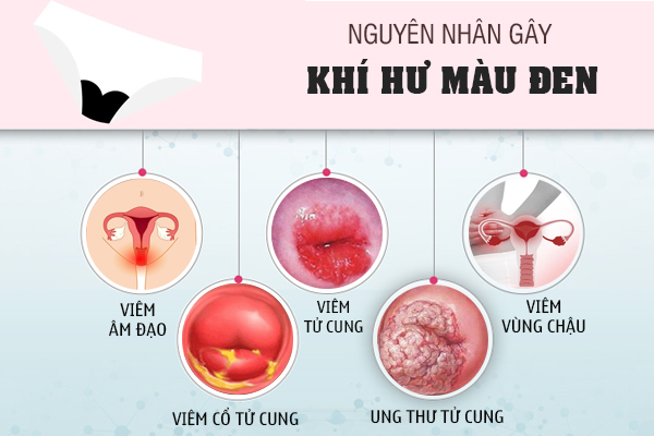 Ra huyết trắng màu đen là dấu hiệu của bệnh gì?