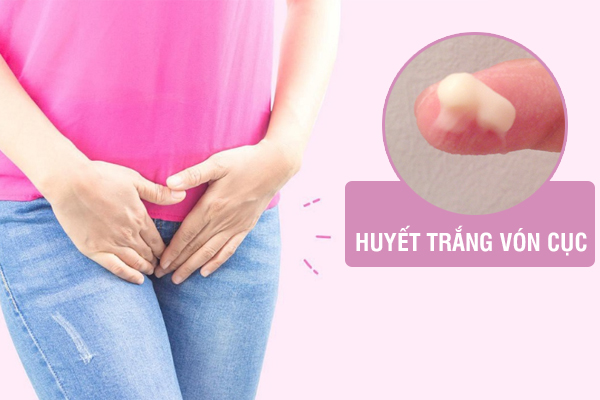 Ra huyết trắng vón cục – Dấu hiệu không nên bỏ qua