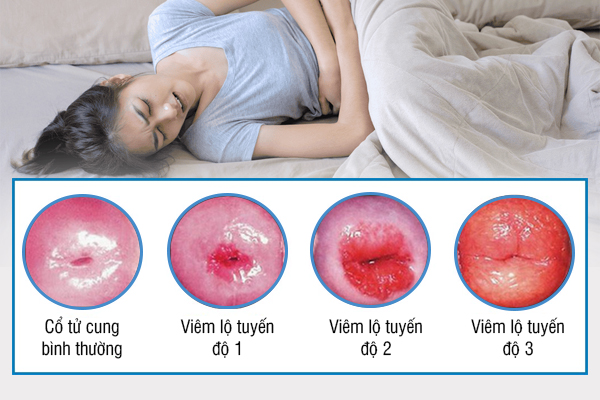 Khí hư hôi là bị gì? Làm sao để hết?