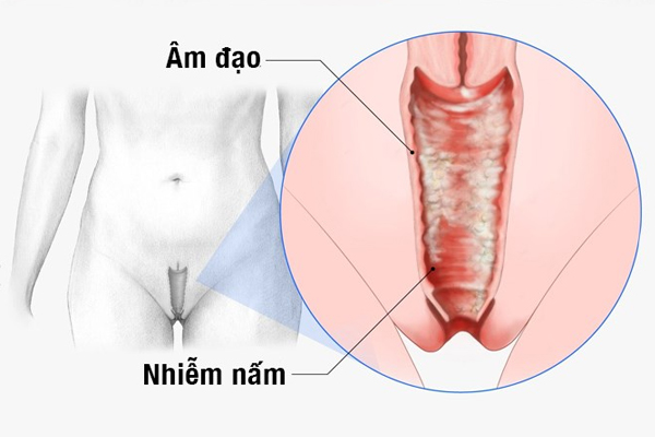 Khí hư hôi là bị gì? Làm sao để hết?