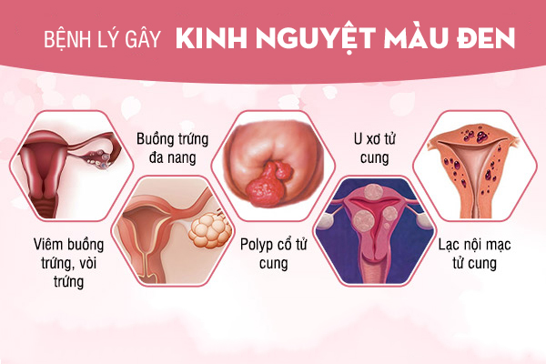 Kinh nguyệt màu đen là bình thường hay bệnh lý?