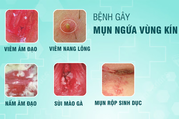 Nổi mụn ngứa vùng kín - Biểu hiện bất thường chị em cần lưu ý