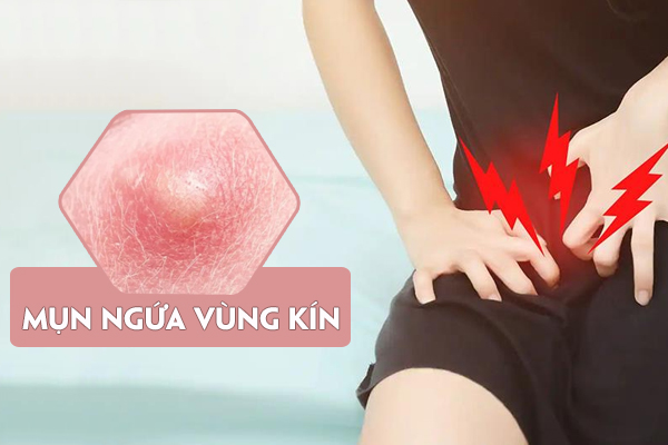 Nổi mụn ngứa vùng kín – Biểu hiện bất thường chị em cần lưu ý