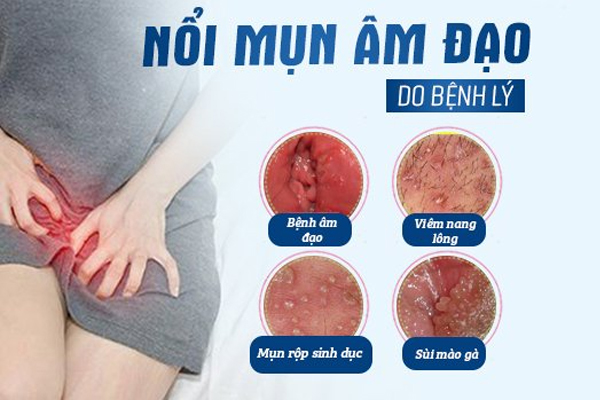 Mụn nhọt âm đạo: Nguyên nhân và cách chữa trị hiệu quả