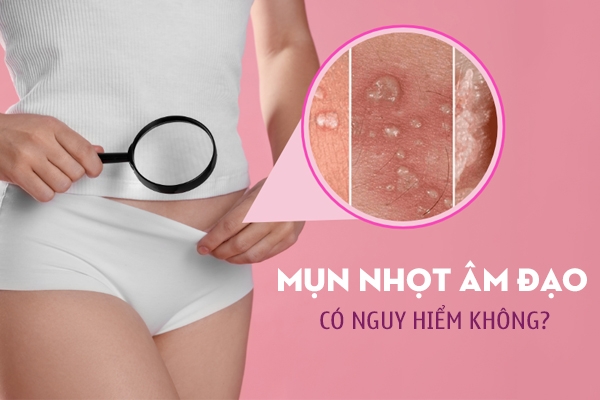 Mụn nhọt âm đạo: Nguyên nhân và cách chữa trị hiệu quả