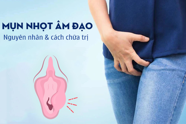 Mụn nhọt âm đạo: Nguyên nhân và cách chữa trị hiệu quả
