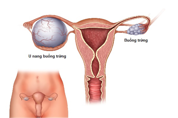 Đi tiểu khó ở nữ là bị bệnh gì? Có sao không?