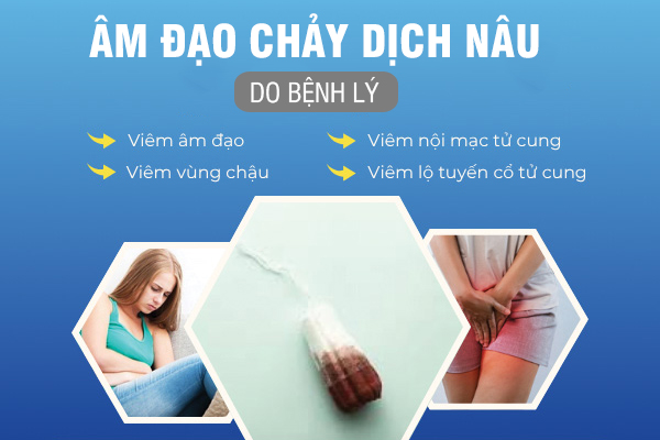 Hiện tượng âm đạo chảy dịch nâu - Cảnh báo bệnh gì?