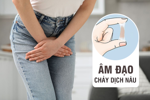 Hiện tượng âm đạo chảy dịch nâu – Cảnh báo bệnh gì?
