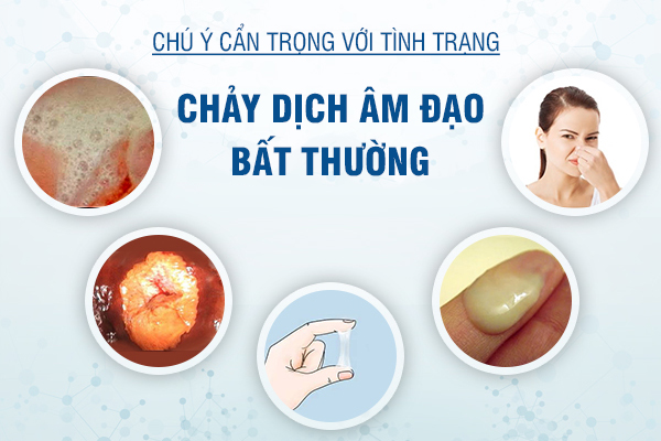 Nguyên nhân gây chảy dịch âm đạo bất thường
