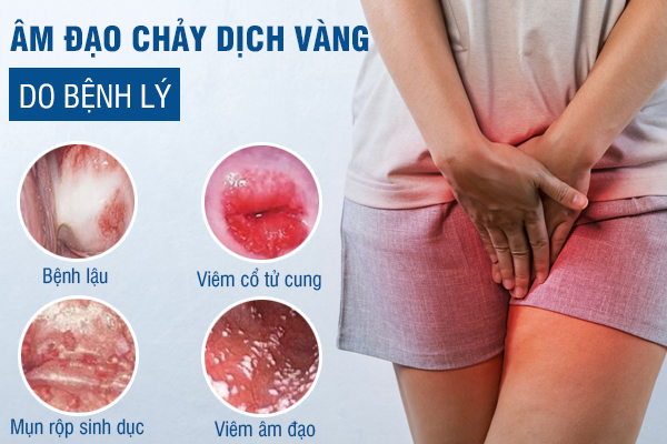 Chảy dịch âm đạo vàng là do đâu? Có sao không?