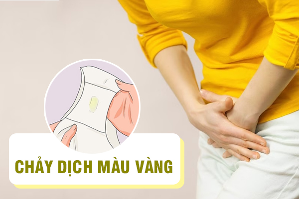Chảy dịch âm đạo vàng là do đâu? Có sao không?