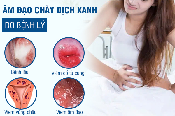 Chảy Dịch Âm Đạo Xanh – Dấu Hiệu Bệnh Phụ Khoa Cần Lưu Ý