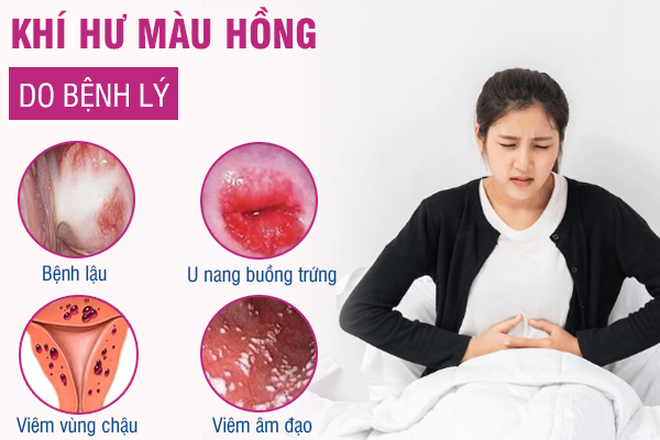 Khí hư màu hồng cho biết điều gì? Có cần chữa trị?