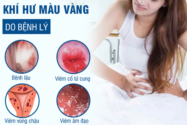 Khí hư màu vàng là do đâu? Khắc phục như thế nào?