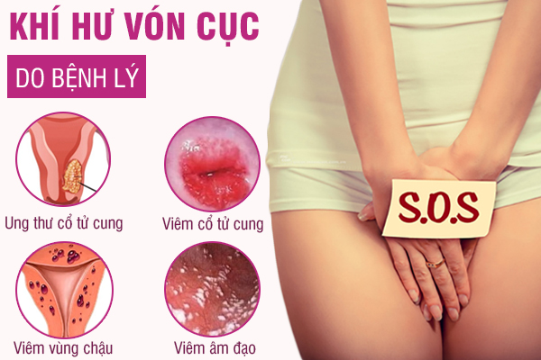 Khí hư vón cục là biểu hiện của những bệnh gì?
