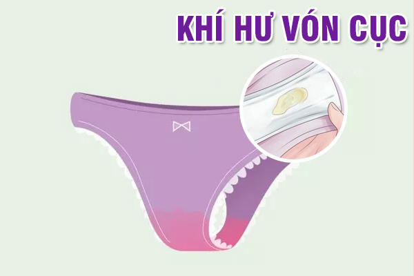 Khí hư vón cục là biểu hiện của những bệnh gì?