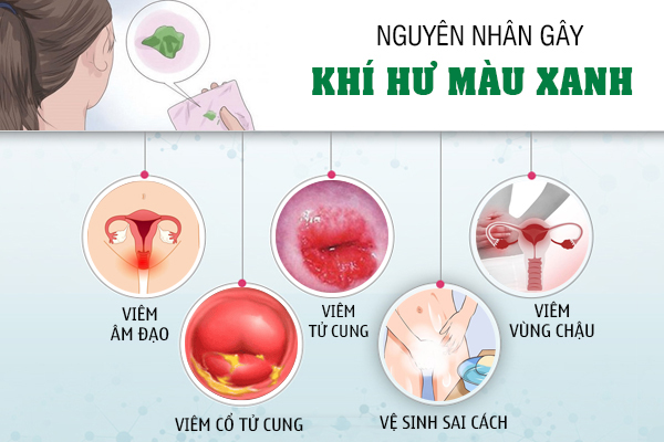 Khí hư xanh - Dấu hiệu cảnh báo nhiều bệnh lý nữ giới không nên xem nhẹ