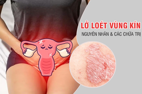 Lở loét vùng kín ở nữ: Nguyên nhân, triệu chứng và cách điều trị