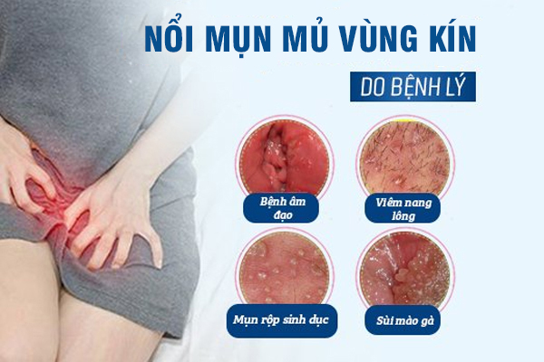 Mụn mủ vùng kín: Nguyên nhân và cách xử lý đúng