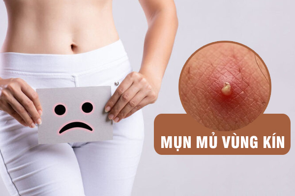Mụn mủ vùng kín: Nguyên nhân và cách xử lý đúng