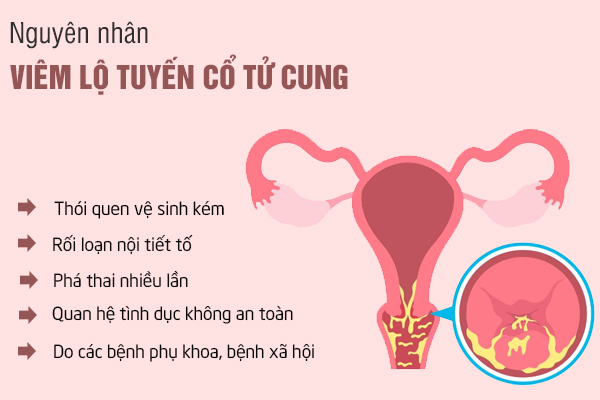 Viêm lộ tuyến cổ tử cung: Nguyên nhân, dấu hiệu và cách chữa trị