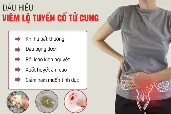 Viêm lộ tuyến cổ tử cung: Nguyên nhân, dấu hiệu và cách chữa trị