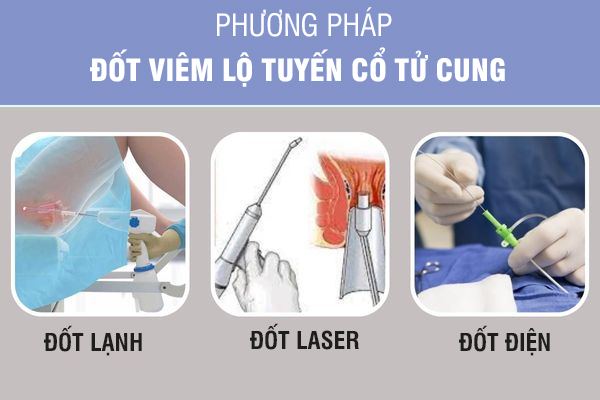 Viêm lộ tuyến cổ tử cung: Nguyên nhân, dấu hiệu và cách chữa trị