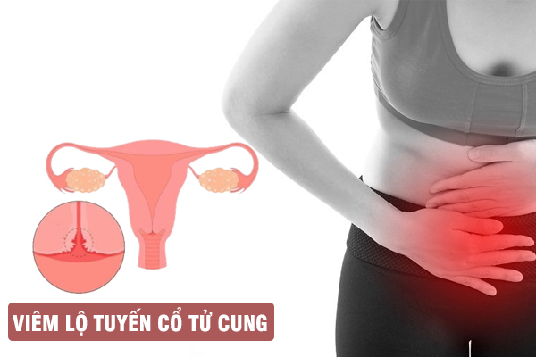 Viêm lộ tuyến cổ tử cung: Nguyên nhân, dấu hiệu và cách chữa trị